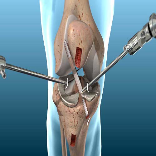 Ligament Reconstruction