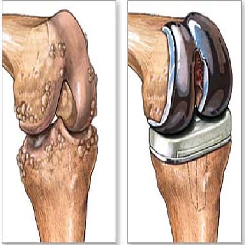 Joint Replacement near me