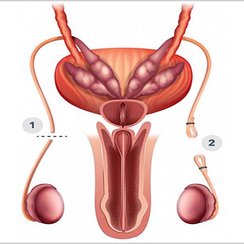 Vasectomy in Noida